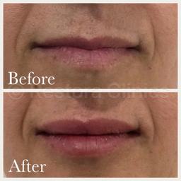 UPDATE: 22/10/18 - NOW FULLY BOOKED - follow us for updates

(NOTE: ALL TREATMENTS ARE DONE BY QUALIFIED & EXPERIENCED MEDICAL DOCTORS/SURGEONS - NOT BEAUTY THERAPISTS, ETC.)

Doctor-led aesthetic clinic in Harley St. and the West End requires models for a featured comparative review of Revolax dermal fillers.

Revolax is a hyaluronic acid dermal filler which originates from South Korea. It's been launched in the UK as an affordable alternative to more premium branded fillers such as JUVEDERM®, TEOSYAL®, RESTYLANE®, and BELOTERO®. The fillers can be used for:

Lip enhancement (lip fillers)
Liquid facelift
Cheek enhancement
Jawline enhancement, etc.

We require the help of willing models to put the claims to the test and to see if Revolax really does compare with top quality fillers.

Models pay a subsidised rate of only £60 per 1.1ml!

- LIMITED AVAILABILITY
- A £20 booking deposit is required to secure your consultation.
- SEE OUR OTHER LISTINGS FOR OFFERS ON PREMIUM BRANDED FILLERS.