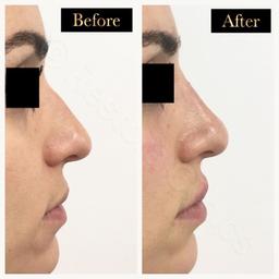 (NOTE: ALL TREATMENTS ARE DONE BY QUALIFIED & EXPERIENCED MEDICAL DOCTORS/SURGEONS - NOT BEAUTY THERAPISTS, ETC.)

Doctor-led cosmetic skin clinic based in central London is looking for before and after models for non-surgical rhinoplasty treatment.

A non-surgical rhinoplasty is a procedure in which the shape of the nose is changed with an injectable filler.

It is a quick procedure which gives instant long-lasting results, without the downtime associated with traditional surgery.

Models receive discounted rate of £190 (full price £495).

Call 07926670936 for bookings.

- LIMITED AVAILABILITY
- A £20 booking deposit is required to secure your consultation.
- IF MAKING A PRIVATE OFFER PLEASE DO NOT ACCEPT ANY OFFERS AS WE WILL NOT BE ABLE TO WRITE BACK TO YOU TO ANSWER YOUR QUESTION

(Check out our shop for more offers on botox treatments, fillers, lip fillers, non-surgical facelift, cheek fillers, etc.)