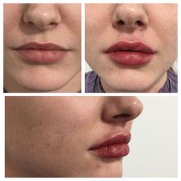 NOTE: ALL TREATMENTS ARE DONE BY QUALIFIED & EXPERIENCED MEDICAL DOCTORS/SURGEONS - NOT BEAUTY THERAPISTS, ETC.)

Doctor-led cosmetic skin clinic based in central London is looking for before and after models for lip filler treatment.

Models receive discounted rate of £160 for 1ml filler (full price £365 for non-models).

Call 07926670936 for bookings.

- LIMITED AVAILABILITY
- A £20 booking deposit is required to secure your consultation.
- IF MAKING A PRIVATE OFFER PLEASE DO NOT ACCEPT ANY OFFERS AS WE WILL NOT BE ABLE TO WRITE BACK TO YOU TO ANSWER YOUR QUESTION.

(Check out our shop for more offers on botox treatments, lip fillers, non-surgical facelift, cheek enhancement, etc.)