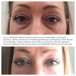 Doctor-led cosmetic skin clinic based in central London is looking for before and after models for tear-trough filler treatment.

The tear trough is the groove at the junction between the lower eyelid and the cheek. As you age, the skin and soft tissue under the eyes begins to thin and lose volume causing the band of tethering fibrous tissue called the orbitomalar ligament to become more visible, resulting in a worsening of dark circles. In youth, due to the surrounding plump fat and thicker overlying skin the ligament is less visible.

In tear-trough filler treatment, a dermal filler is placed under the soft tissue around the orbitomalar ligament, thereby lifting the soft tissues, making the tear-troughs appear shallower.

Results are instant and long lasting.

Full price = £495
Model rate = 190

ALL TREATMENTS PERFORMED BY EXPERIENCED MEDICAL DOCTORS

LIMITED AVAILABILITY!
Call 07926670936 for bookings.

(See shop for offers on botox, fillers, cheek fillers, lip fillers, etc.)