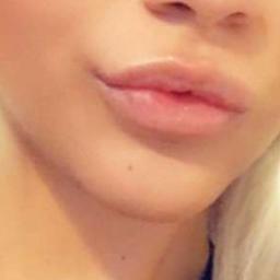 LIP ENHANCEMENTS-FOR BEAUTIFUL LOOKING LIPS
QUALIFIED NURSE 18 YEARS EXPERIENCE
FULLY QUALIFIED AESTHETICS PRACTITIONER
FULLY INSURED WITH HAMILTON FRASER
