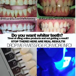 cosmetic teeth whitening practitioner based in the West Midlands.
real people and real results. instant results!