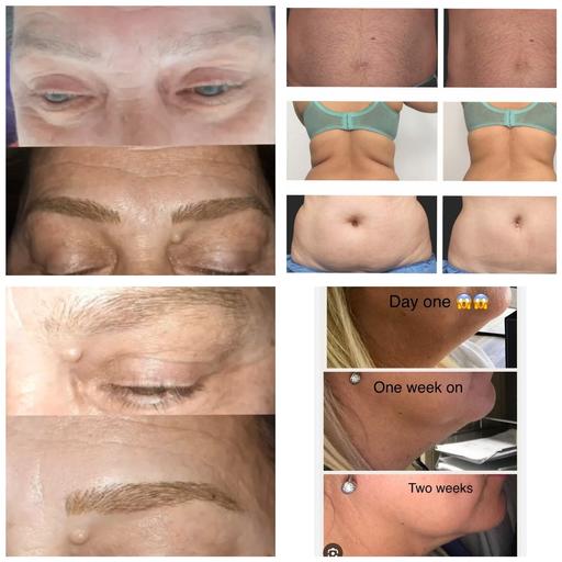 Buy & Sell South East London Nunhead - South East London - Photos for microblading brows and fat dissolving