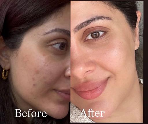 Buy & Sell Prescot Knowsley - Photos for PanOxyl Acne Treatment 10% Benzoyl Peroxide