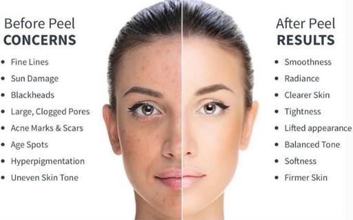 Buy & Sell Greenford Ealing - Photos for Face peels & micro needling sessions